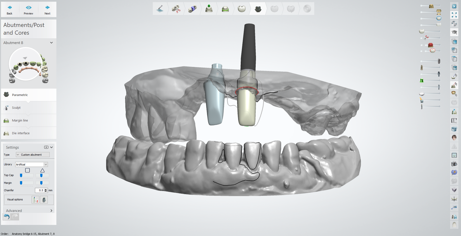 Custom Abutment Design
